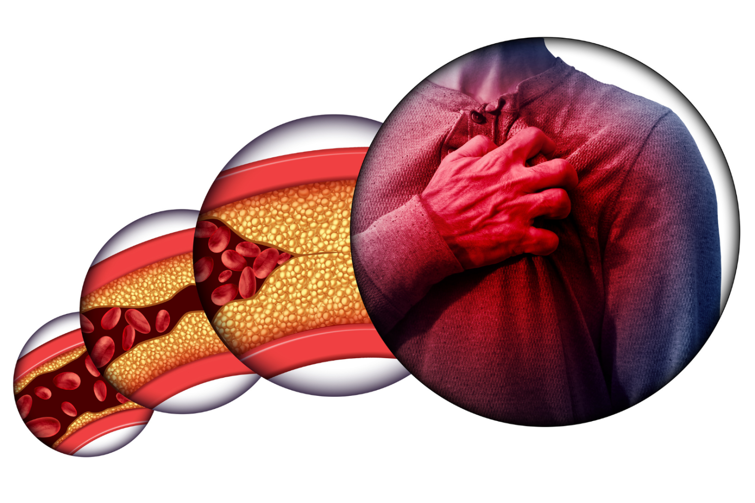 Ilustracja przedstawiająca przekrój naczynia krwionośnego z widocznym zwężeniem światła przez złogi oraz dłoń przyłożoną do klatki piersiowej