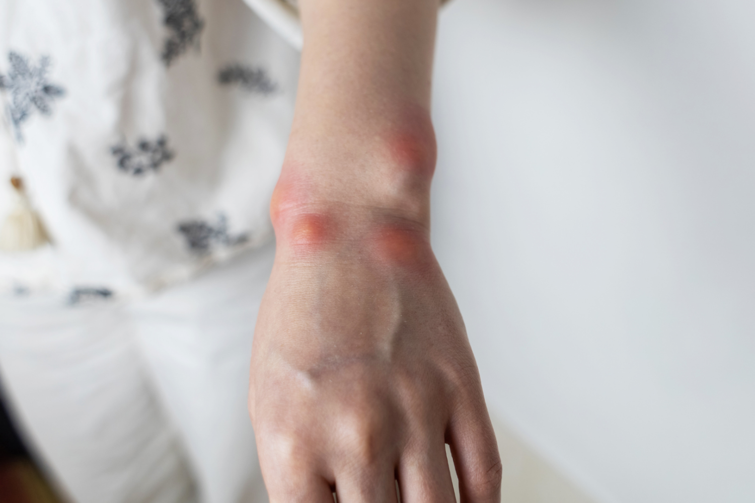 Zbliżenie na przedramię z kilkoma czerwonymi, wypukłymi zmianami skórnymi w okolicy nadgarstka, widoczne miejscowe zaczerwienienie skóry