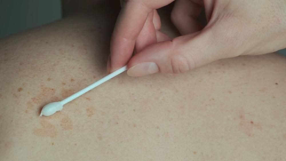 Łupież pstry na plecach, który jest smarowany patyczkiem do uszu