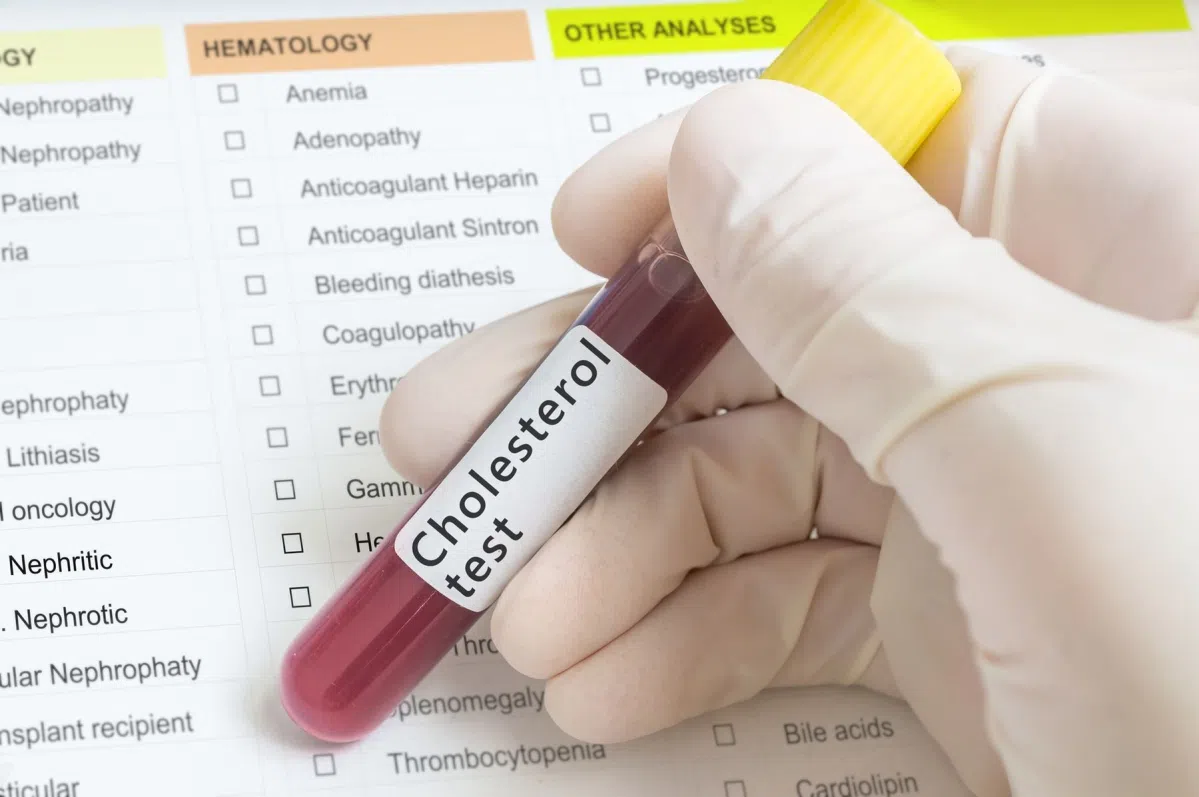 Lipidogram : normy i opis badania