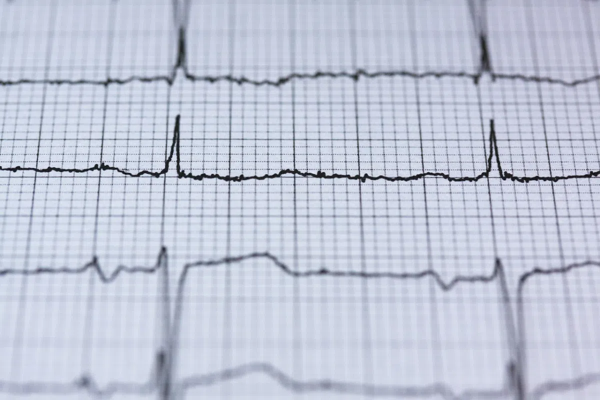 wykres z ekg