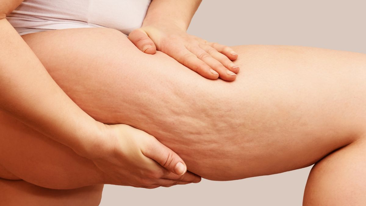 Lipodytrofia typu kobiecego