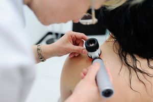 Dermatoskopia wykonywana w gabinecie dermatologicznym z użyciem dermatoskopu przyłożonego do znamienia na skórze pleców, obraz przedstawiający badanie zmian skórnych w kierunku czerniaka oraz ocenę pieprzyków i innych znamion barwnikowych.
