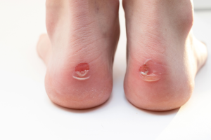 Zbliżenie na pięty stóp z widocznymi otarciami skóry i powierzchownymi uszkodzeniami naskórka, tło w jasnym kolorze