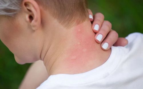 Alergia skórna: objawy u dzieci i dorosłych. Jak ją leczyć?