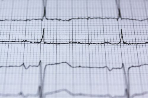 Migotanie Przedsionków (AFib): Kompleksowy Przewodnik po Objawach, Przyczynach i Leczeniu
