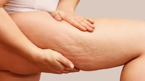 Lipodystrofia: co to jest? Przyczyny, objawy i leczenie 