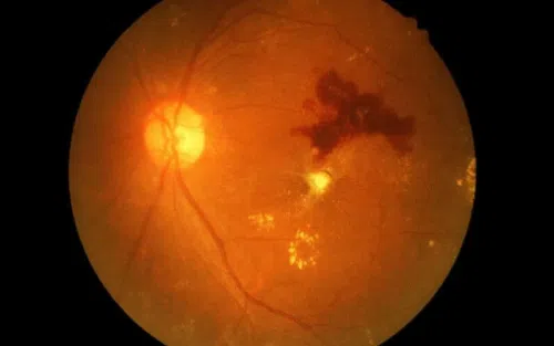 Retinopatia cukrzycowa : objawy. Czy jest uleczalna?