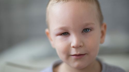 Spuchnięte oko u dziecka: przyczyny, leczenie i domowe sposoby