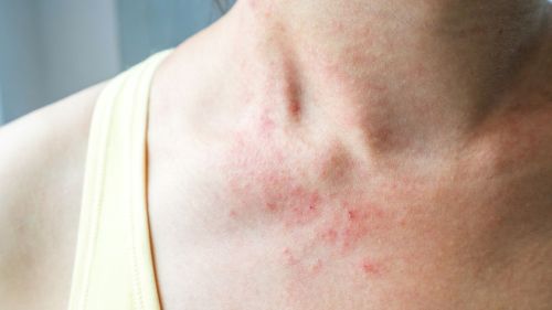 Szkarlatyna (płonica) – objawy, przyczyny, leczenie u dzieci i dorosłych