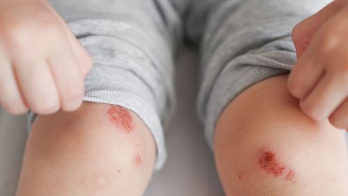 Mocno zdarte kolano u dziecka – jak oczyścić i opatrzyć zdartą skórę na kolanie?